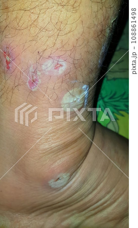 Diabetes mellitus wound, blisters, boils, infections, rash of the foot. Infected wound, treatment of a diabetic patient's leg infection. skin itchy, skin disease, skin problems 108861498