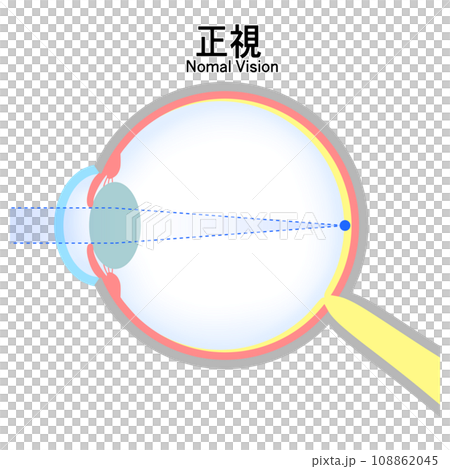 Illustration of normal eyeball (emmetropia) 108862045