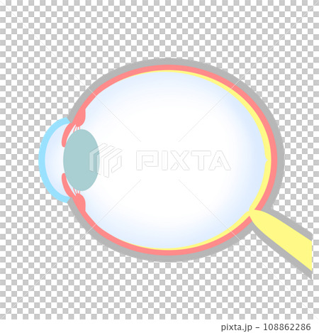 Illustration of an eyeball with axial myopia 108862286