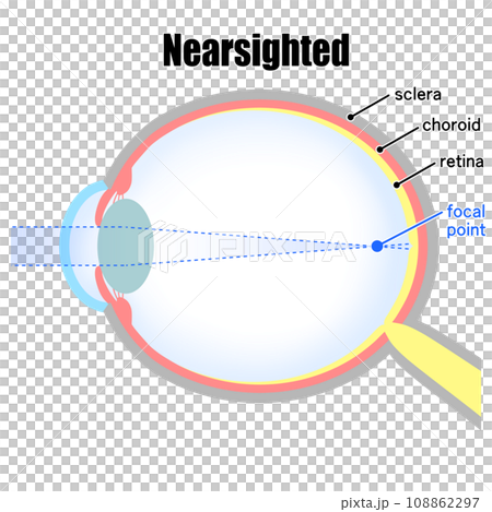 Illustration of an eyeball with axial myopia Illustration of an eyeball with axial myopia 108862297