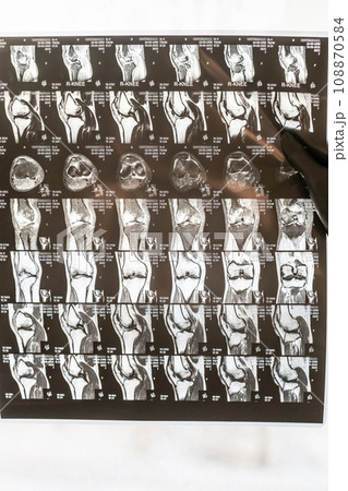 Knee joint x-ray or MRI. Doctor pointed on area of knee joint, where pathology or problem is detected, such fracture, destruction of joint, osteoarthritis, magnetic resonance enterography. 108870584