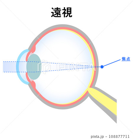 軸性遠視の眼球のイラスト 軸性遠視の眼球のイラスト 108877711