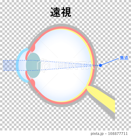 軸性遠視の眼球のイラスト 軸性遠視の眼球のイラスト 108877711