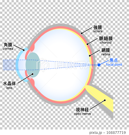 Illustration of an eyeball with axial hyperopia Illustration of an eyeball with axial hyperopia 108877719