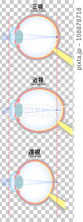 正視・近視・遠視の眼球のイラスト 正視・近視・遠視の眼球のイラスト 108878718