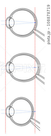 正視・近視・遠視の眼球のイラスト 正視・近視・遠視の眼球のイラスト 108878719