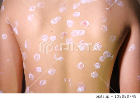 水痘(水疱瘡)で発疹の出たため、患部に消炎・鎮痒剤のカチリを塗った様子 水痘(水疱瘡)で発疹の出たため、患部に消炎・鎮痒剤のカチリを塗った様子 108888749