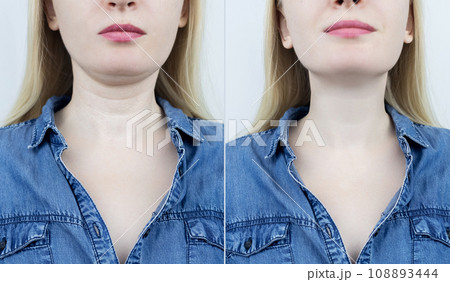 Venus rings. Skin folds on the neck due to loss of elasticity. Removal of wrinkles using plastic surgery, botulinum toxin, contouring or tightening the skin on neck. Correction of cosmetic defects Venus rings. Skin folds on the neck due to loss of elasticity. Removal of wrinkles using plastic surgery, botulinum toxin, contouring or tightening the skin on neck. Correction of cosmetic defects 108893444