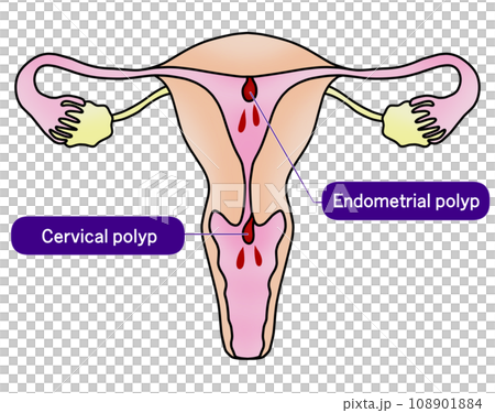 Illustration of endometrial polyp and cervical polyp 108901884