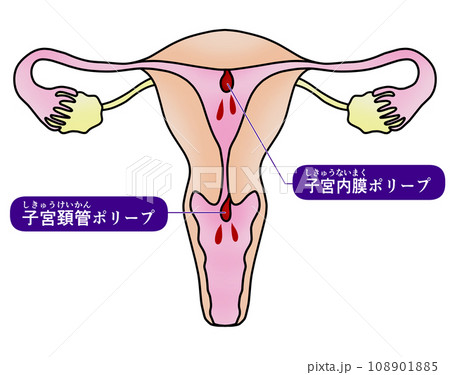 子宮内膜ポリープと子宮頚管ポリープのイラスト 108901885