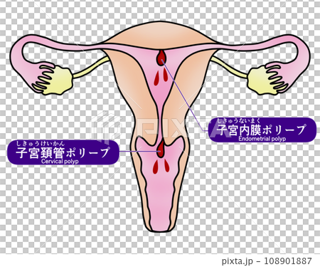 子宮内膜ポリープと子宮頚管ポリープのイラスト 108901887