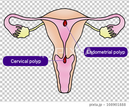 子宮內膜息肉與子宮頸息肉圖解 108901888