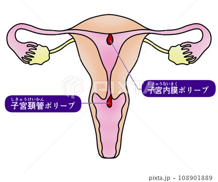 子宮内膜ポリープと子宮頚管ポリープのイラスト 108901889