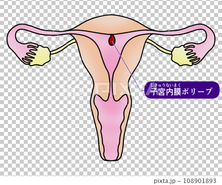 子宮內膜息肉與子宮頸息肉圖解 108901893