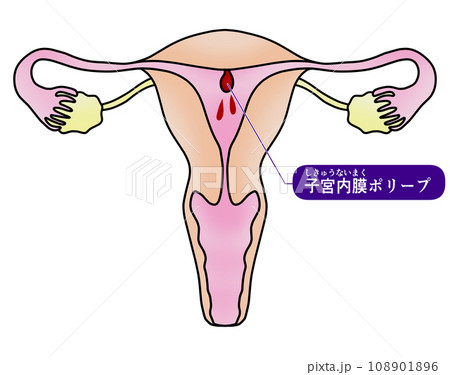 子宮内膜ポリープと子宮頚管ポリープのイラスト 108901896