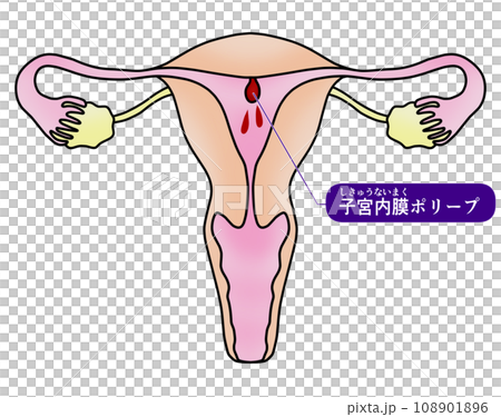 子宮内膜ポリープと子宮頚管ポリープのイラスト 108901896