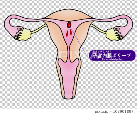 子宮內膜息肉與子宮頸息肉圖解 108901897