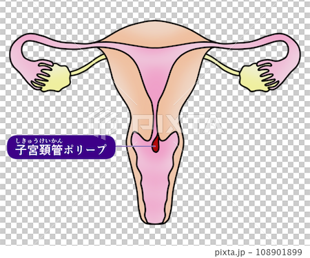 子宮内膜ポリープと子宮頚管ポリープのイラスト 108901899