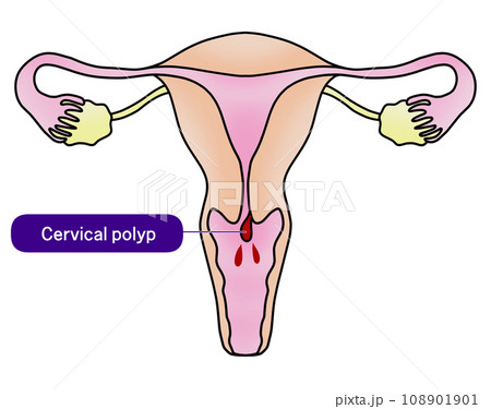 子宮内膜ポリープと子宮頚管ポリープのイラスト 108901901