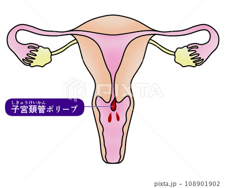 子宮内膜ポリープと子宮頚管ポリープのイラスト 108901902