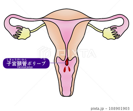 子宮内膜ポリープと子宮頚管ポリープのイラスト 108901903