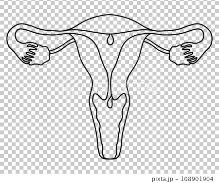 子宮内膜ポリープと子宮頚管ポリープのイラスト 108901904