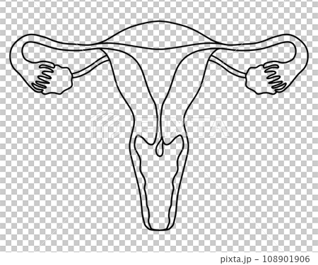 子宮内膜ポリープと子宮頚管ポリープのイラスト 108901906