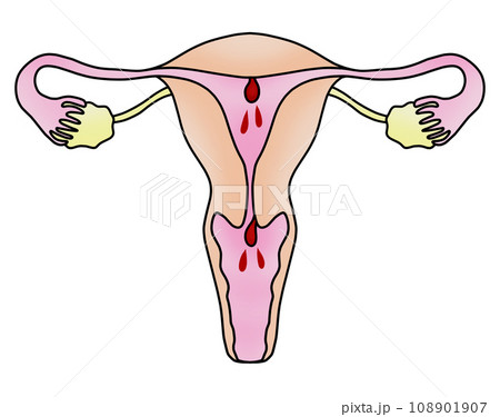 子宮内膜ポリープと子宮頚管ポリープのイラスト 108901907