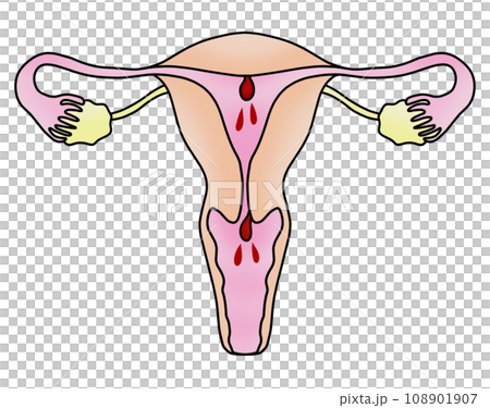 子宮内膜ポリープと子宮頚管ポリープのイラスト 108901907