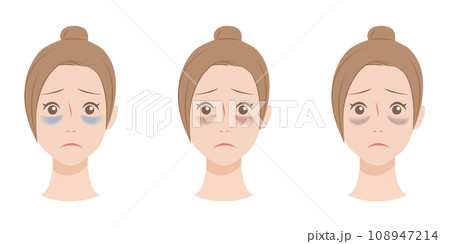 目のクマの種類 目のクマの種類 108947214