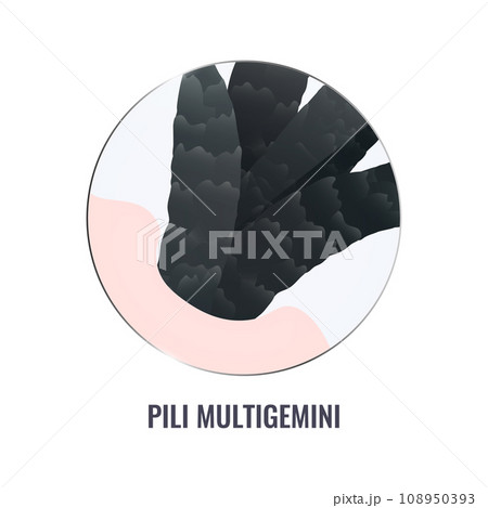 Pili multigemini hair disorder in close up 108950393