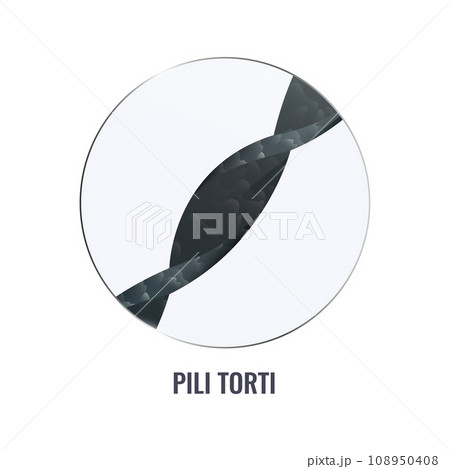 Pili torti hair disorder in close up 108950408