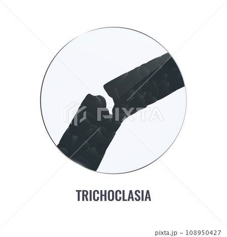 Trichoclasia hair brittle disorder in close up 108950427