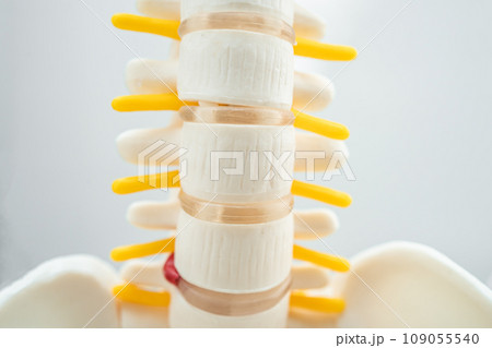 Lumbar spine displaced herniated disc fragment, spinal nerve and bone. Model for treatment medical in the orthopedic department. Lumbar spine displaced herniated disc fragment, spinal nerve and bone. Model for treatment medical in the orthopedic department. 109055540