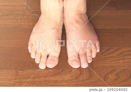 痛風発作 (左足の人差指と薬指と足の甲の腫れ) 痛風発作 (左足の人差指と薬指と足の甲の腫れ) 109104092