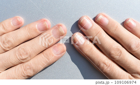 Fungal nail infection, onycholysis after shellac or gel-varnish Fungal nail infection, onycholysis after shellac or gel-varnish 109106974