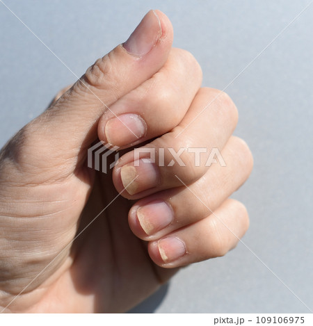 Fungal nail infection, onycholysis after shellac or gel-varnish 109106975