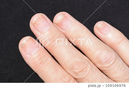 Fungal nail infection, onycholysis after shellac or gel-varnish 109106976