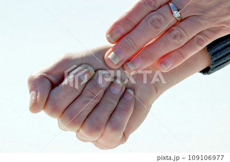 Fungal nail infection, onycholysis after shellac or gel-varnish Fungal nail infection, onycholysis after shellac or gel-varnish 109106977