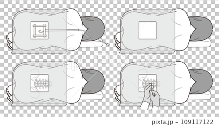 硬脊膜外麻醉、蜘蛛網膜下腔麻醉、無痛分娩、剖腹產、麻醉、注射、麻醉科醫師、插圖 109117122