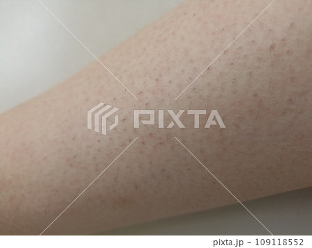 rash eczema dermatitis on leg. inflammation of skin rash eczema dermatitis on leg. inflammation of skin 109118552