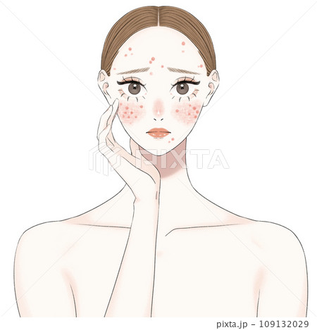 顔のニキビに悩む女性 109132029