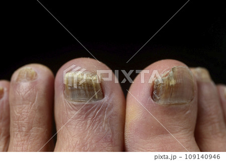 足爪水虫のクローズアップ 足爪水虫のクローズアップ 109140946