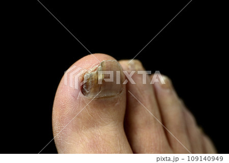 足爪水虫のクローズアップ 109140949