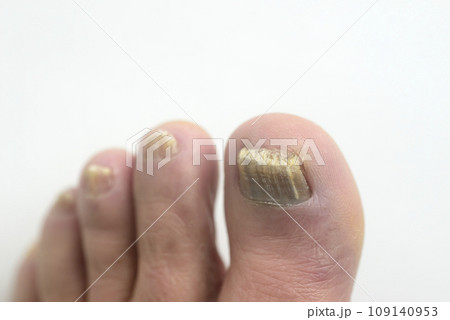 足爪水虫のクローズアップ 足爪水虫のクローズアップ 109140953
