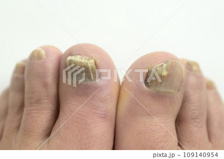 足爪水虫のクローズアップ 109140954