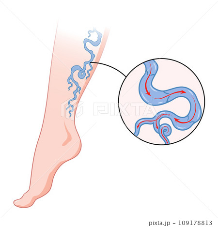 Varicose veins. Blue blood vessel visible through the skin, abnormally swollen leg. Vascular disease diagnostic and treatment. Venous insufficiency medical disease 109178813