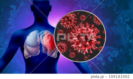 Pneumonia Outbreak Pneumonia Outbreak 109181002