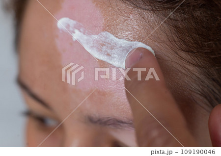 Vitiligo. A close-up portrait of a woman with no skin pigmentation on her forehead. Girl smears sunscreen on a white spot on the skin of the face. Autoimmune disease. 109190046