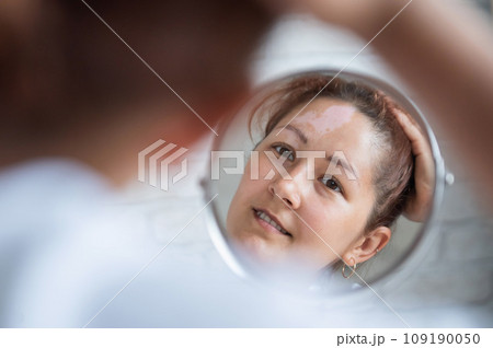 A woman with vitiligo looks in the mirror. Reflection in a table mirror a girl with a white spot on her forehead. Autoimmune disease. Lack of skin pigmentation. 109190050